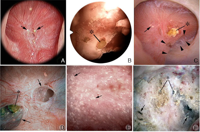 Why Do Kidney Stones Cause Pain Kidney Stone Evaluation And Treatment Program