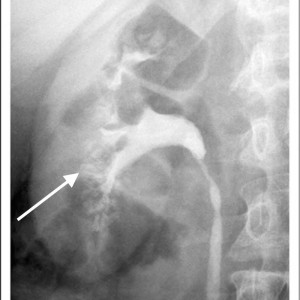 IVP Medullary Sponge