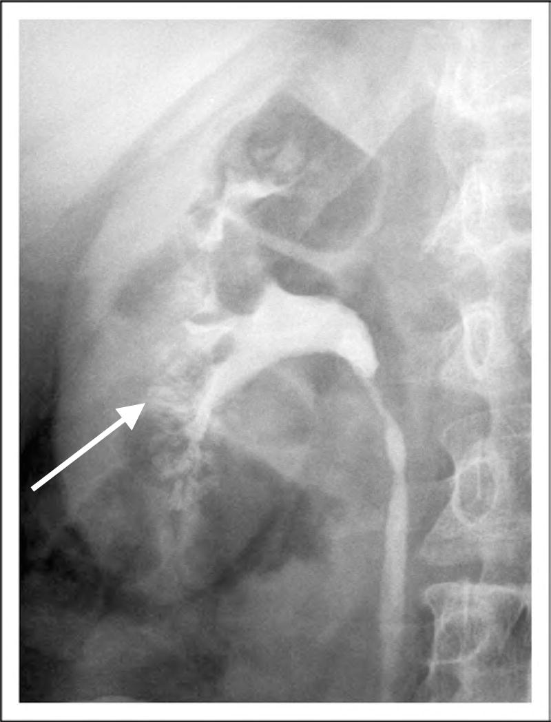 The Diagnostic Dilemma of Medullary Sponge Kidney Kidney Stone