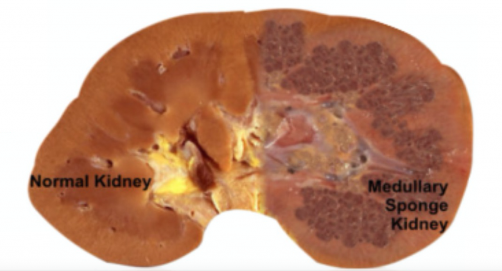 The Diagnostic Dilemma of Medullary Sponge Kidney | Kidney Stone