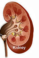 Why Do Kidney Stones Cause Pain Kidney Stone Evaluation And Treatment Program