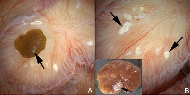 kidney stone removal